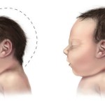 Why Zika Virus Is Sparking Public Emergency