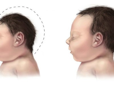 Microcephaly comparison