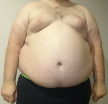 Obese Man