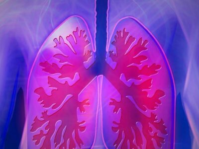 Lungs of a patient with COPD